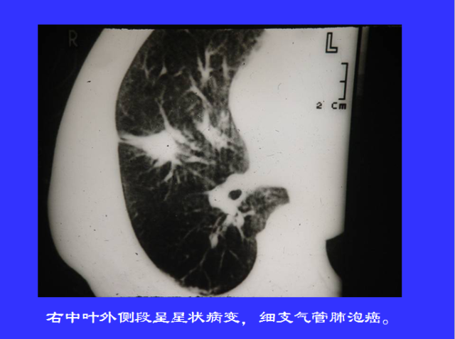 胸部CT阅读与诊断