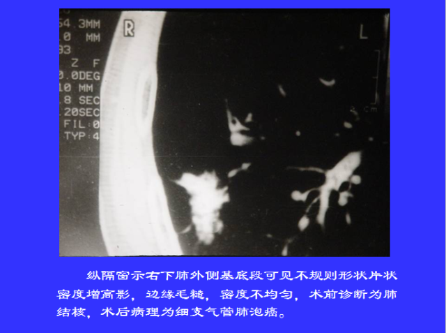 胸部CT阅读与诊断