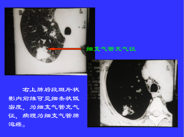 胸部CT阅读与诊断