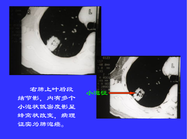胸部CT阅读与诊断