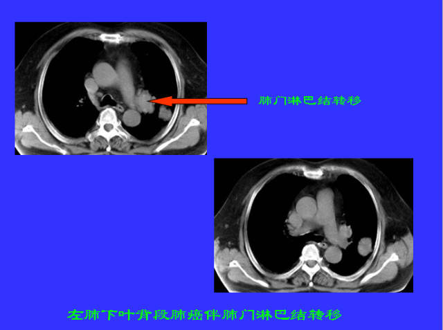 胸部CT阅读与诊断