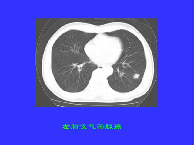 胸部CT阅读与诊断