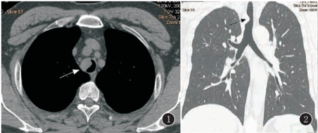 气管Rosa-iDorfman病