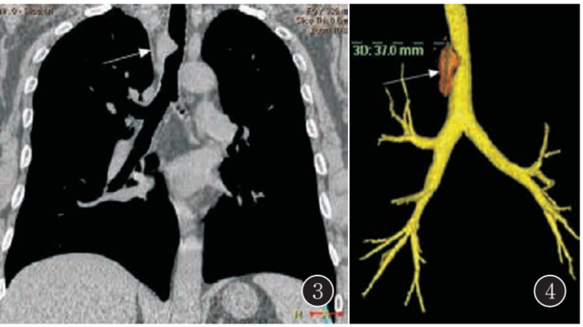 气管Rosa-iDorfman病