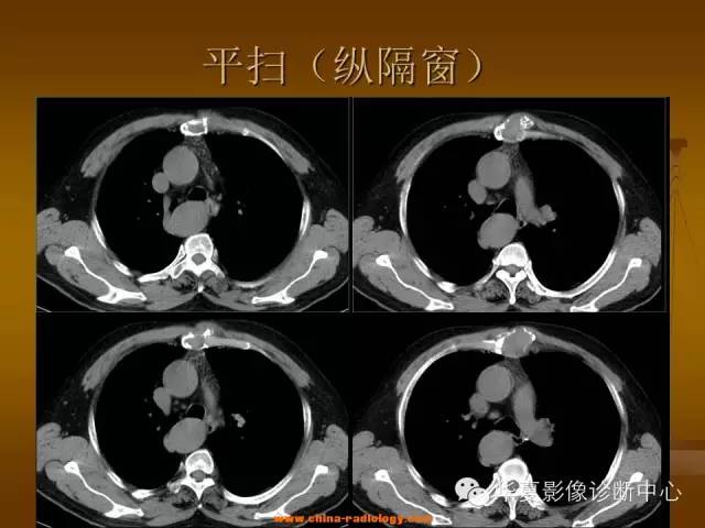 【病例学习】胸骨浆细胞骨髓瘤一例CT诊断与鉴别