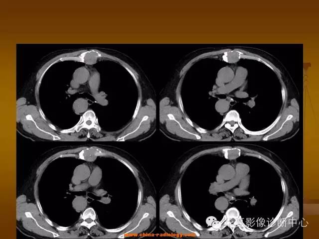 【病例学习】胸骨浆细胞骨髓瘤一例CT诊断与鉴别