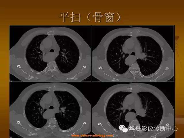 【病例学习】胸骨浆细胞骨髓瘤一例CT诊断与鉴别