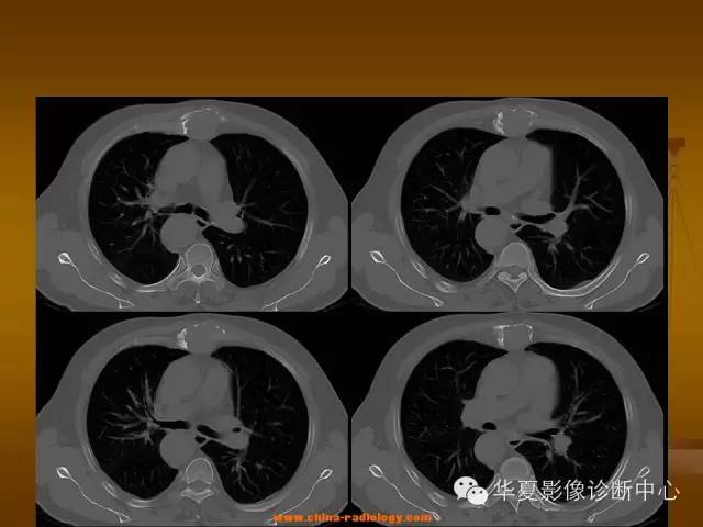 【病例学习】胸骨浆细胞骨髓瘤一例CT诊断与鉴别