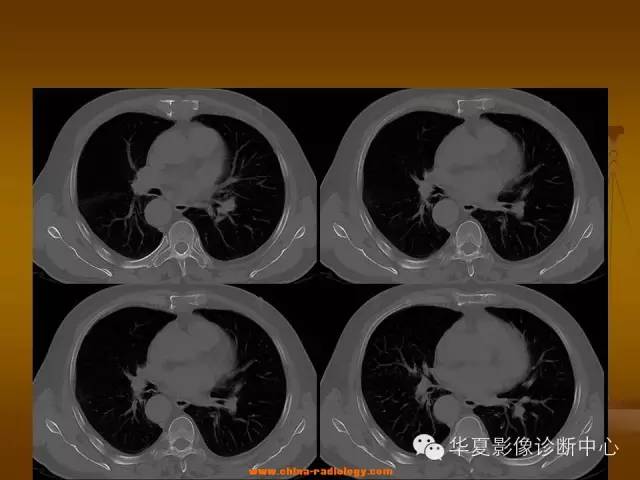 【病例学习】胸骨浆细胞骨髓瘤一例CT诊断与鉴别