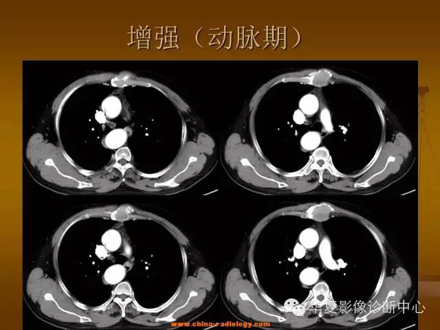 【病例学习】胸骨浆细胞骨髓瘤一例CT诊断与鉴别