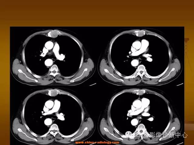 【病例学习】胸骨浆细胞骨髓瘤一例CT诊断与鉴别