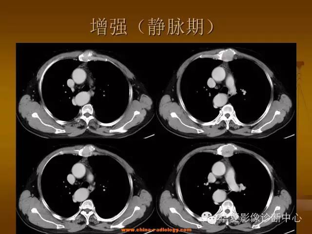 【病例学习】胸骨浆细胞骨髓瘤一例CT诊断与鉴别