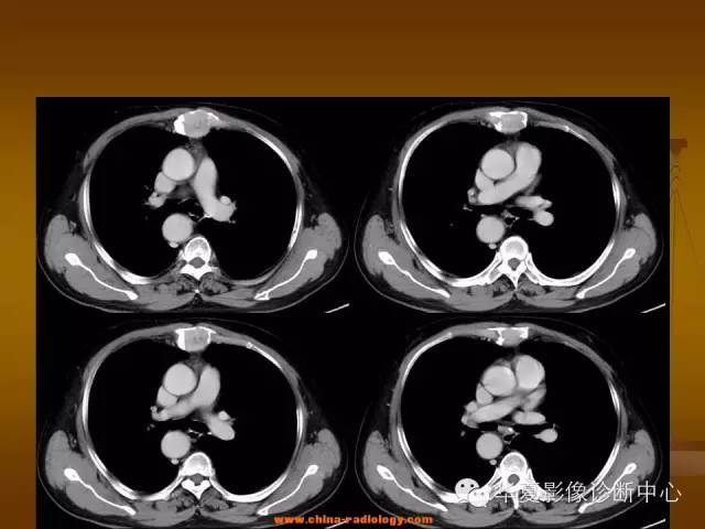 【病例学习】胸骨浆细胞骨髓瘤一例CT诊断与鉴别