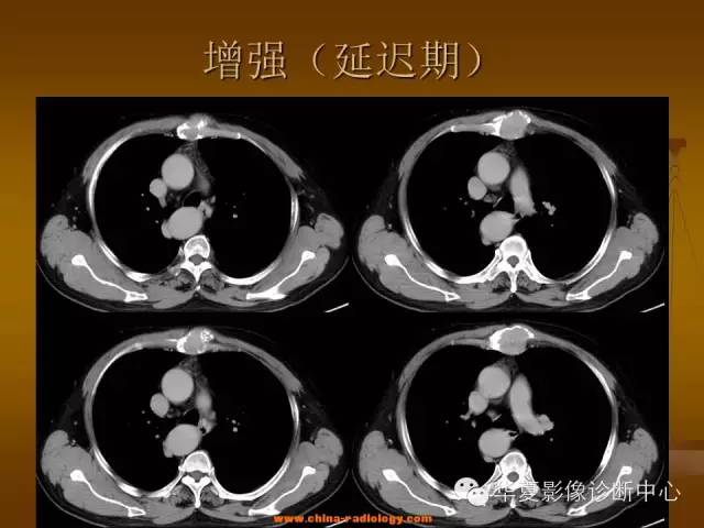 【病例学习】胸骨浆细胞骨髓瘤一例CT诊断与鉴别