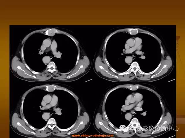 【病例学习】胸骨浆细胞骨髓瘤一例CT诊断与鉴别