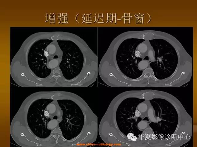 【病例学习】胸骨浆细胞骨髓瘤一例CT诊断与鉴别