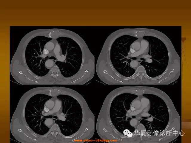 【病例学习】胸骨浆细胞骨髓瘤一例CT诊断与鉴别