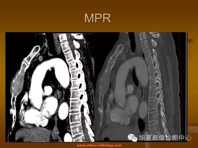【病例学习】胸骨浆细胞骨髓瘤一例CT诊断与鉴别