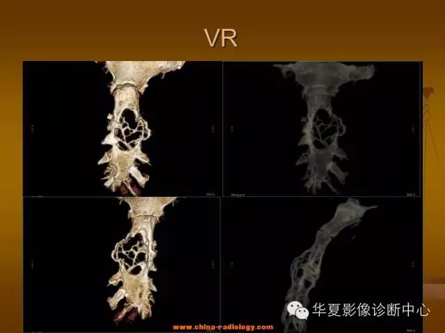 【病例学习】胸骨浆细胞骨髓瘤一例CT诊断与鉴别
