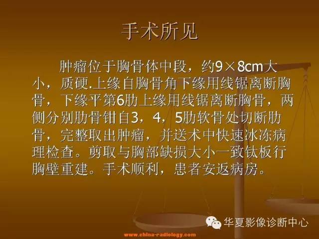 【病例学习】胸骨浆细胞骨髓瘤一例CT诊断与鉴别