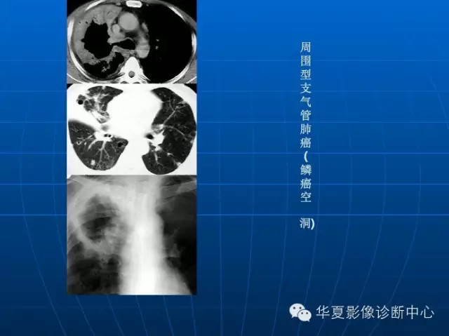 肺部空洞（样）病灶的影像诊断