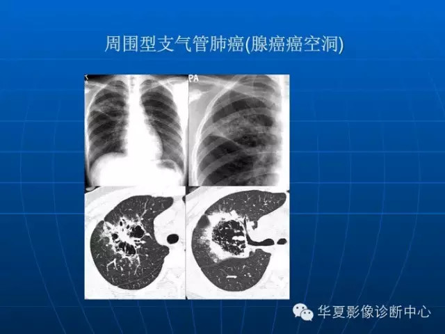 肺部空洞（样）病灶的影像诊断