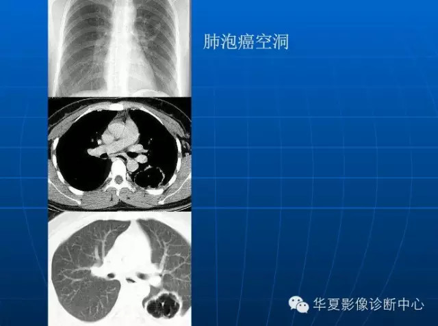 肺部空洞（样）病灶的影像诊断