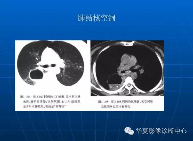 肺部空洞（样）病灶的影像诊断