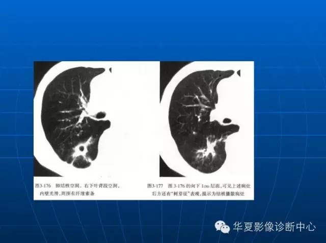 肺部空洞（样）病灶的影像诊断