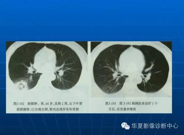 肺部空洞（样）病灶的影像诊断