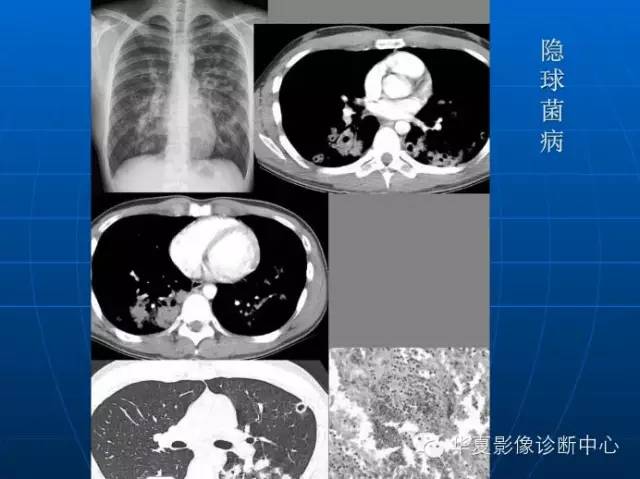 肺部空洞（样）病灶的影像诊断