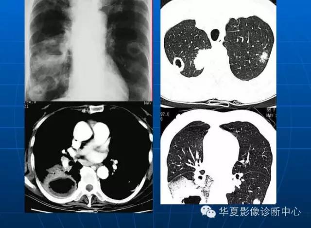 肺部空洞（样）病灶的影像诊断