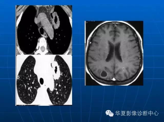 肺部空洞（样）病灶的影像诊断