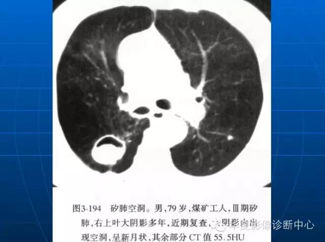 肺部空洞（样）病灶的影像诊断