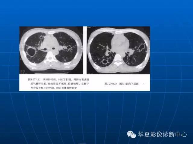 肺部空洞（样）病灶的影像诊断