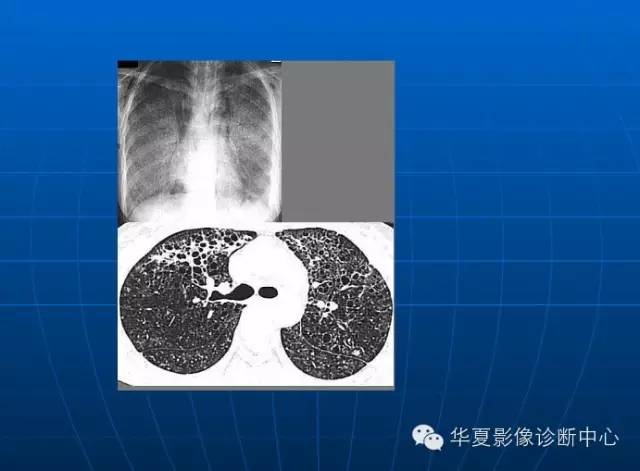 肺部空洞（样）病灶的影像诊断