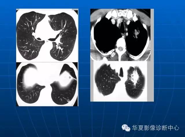 肺部空洞（样）病灶的影像诊断