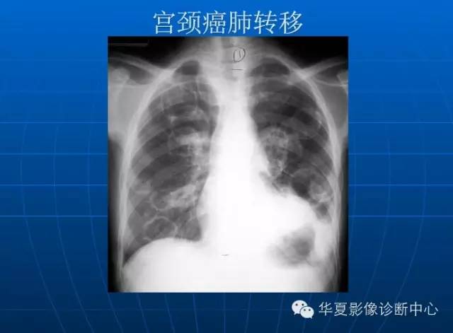 肺部空洞（样）病灶的影像诊断