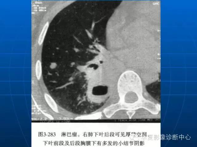 肺部空洞（样）病灶的影像诊断
