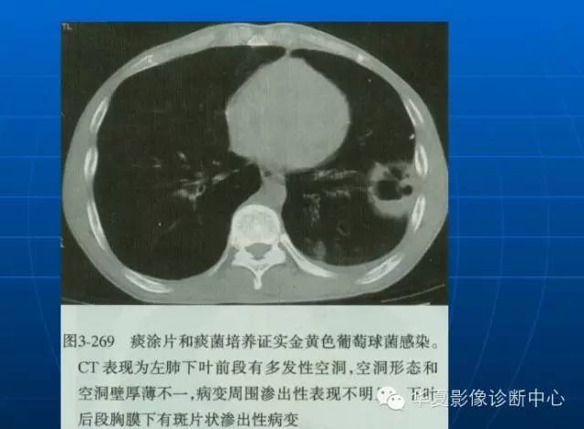 肺部空洞（样）病灶的影像诊断