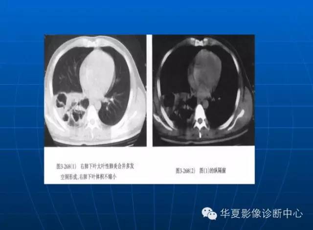肺部空洞（样）病灶的影像诊断