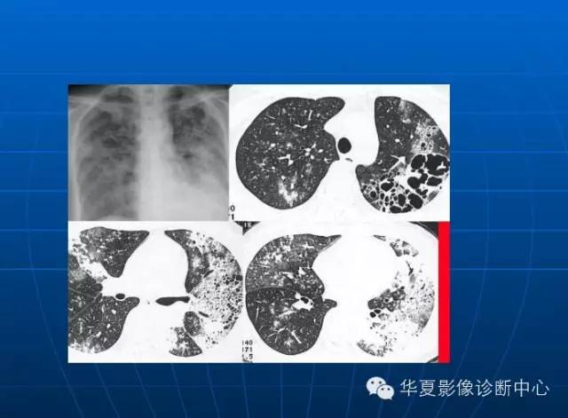 肺部空洞（样）病灶的影像诊断
