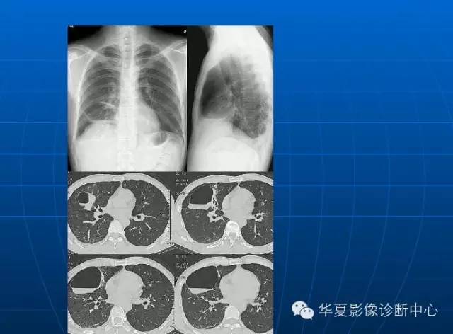 肺部空洞（样）病灶的影像诊断