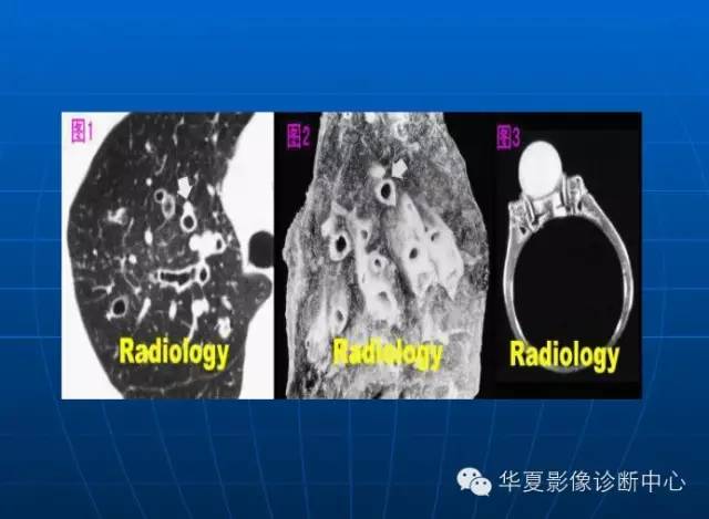 肺部空洞（样）病灶的影像诊断