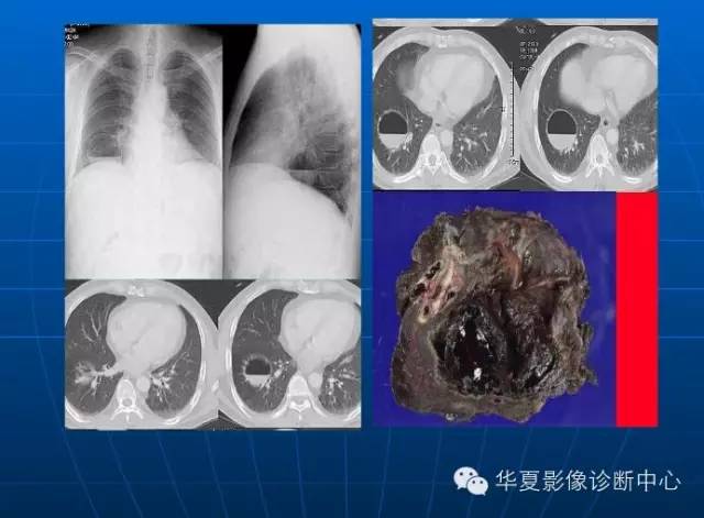 肺部空洞（样）病灶的影像诊断