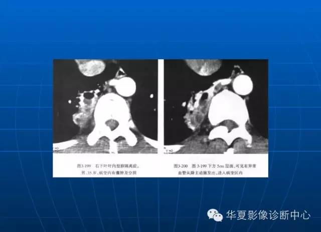 肺部空洞（样）病灶的影像诊断