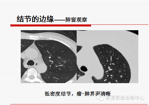 孤立性肺结节/肿块及相关CT征像判断的准则