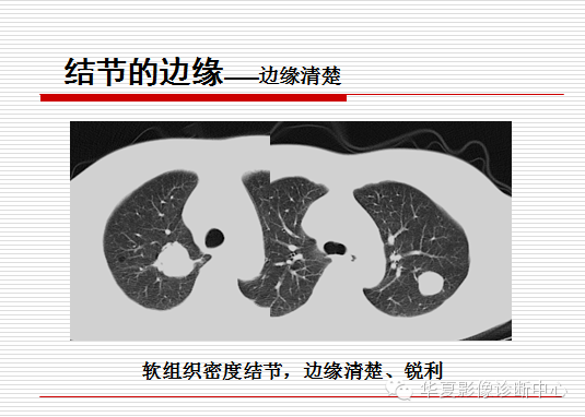 孤立性肺结节/肿块及相关CT征像判断的准则