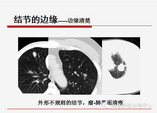 孤立性肺结节/肿块及相关CT征像判断的准则