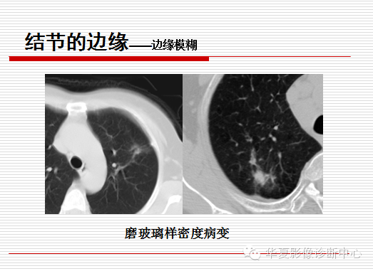 孤立性肺结节/肿块及相关CT征像判断的准则